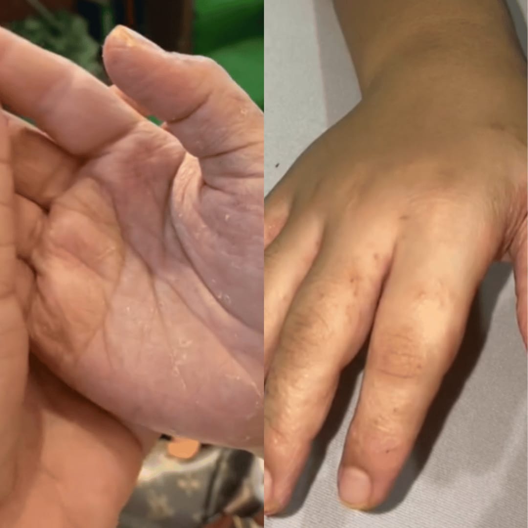Customer photo review of HOCL Skin Healing Duo