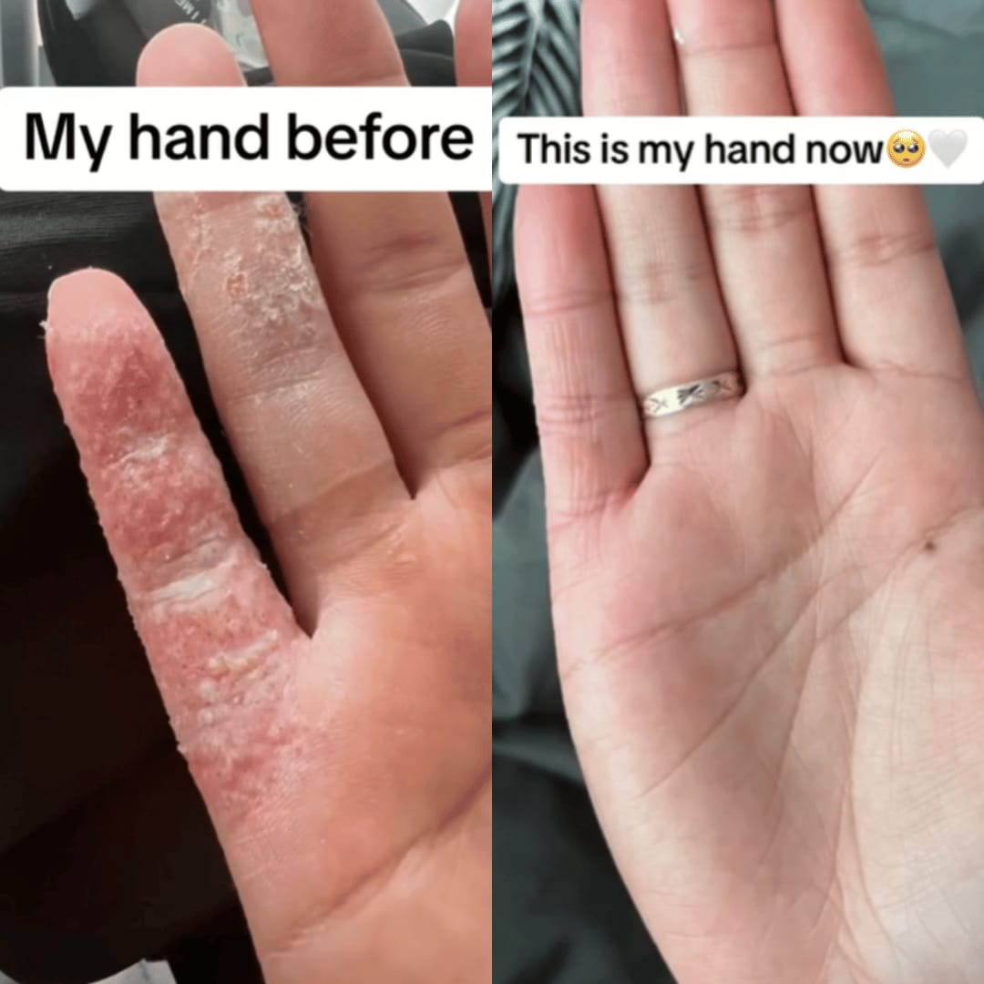 Customer photo review of HOCL Skin Healing Duo