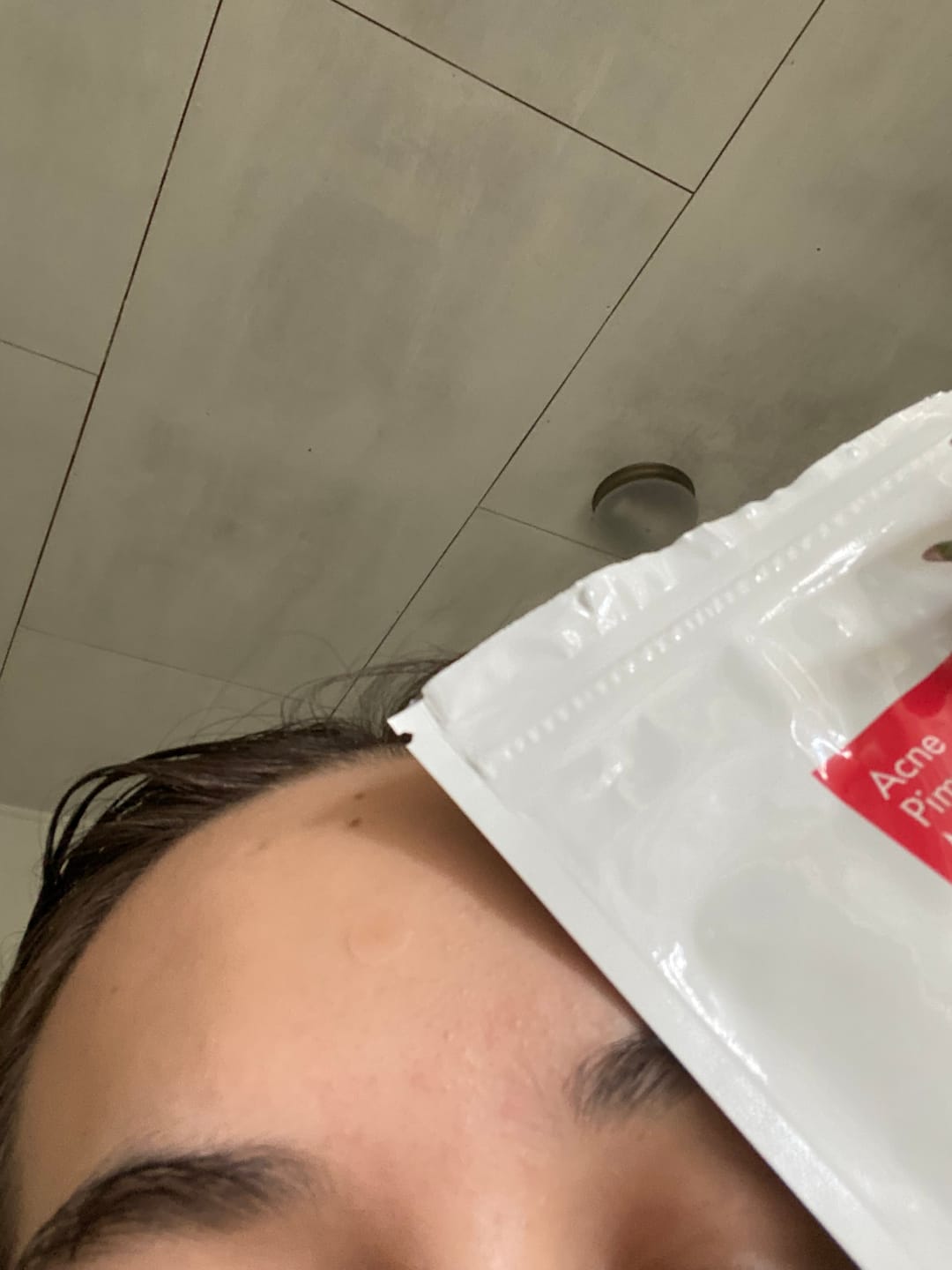 Customer photo review of Acne Pimple Master Patch (24 patches)
