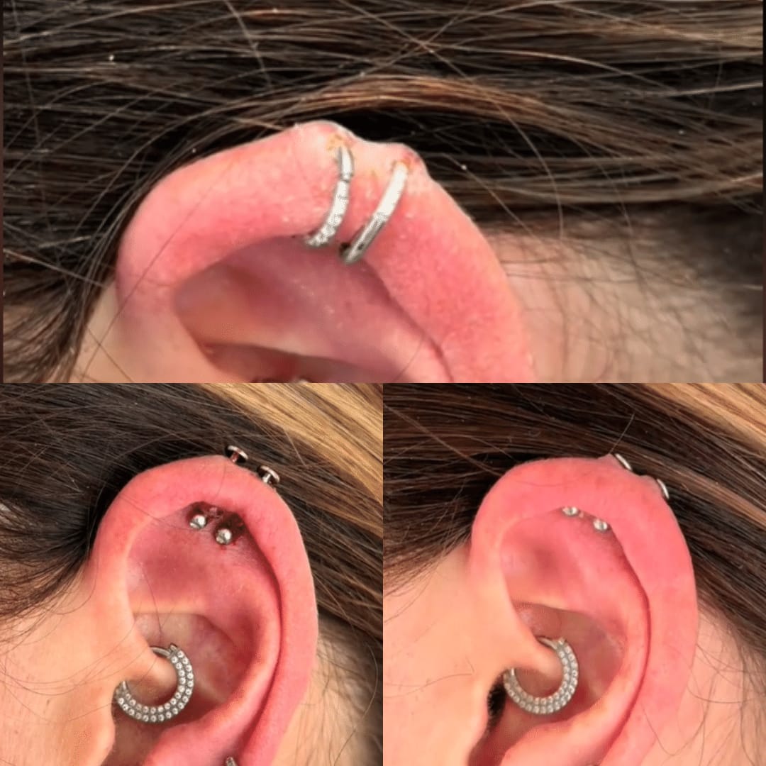 Customer photo review of Keloid Bump Shrinking Duo