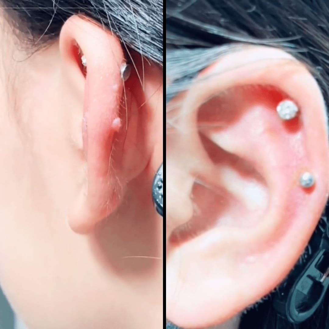 Customer photo review of Keloid Bump Shrinking Duo