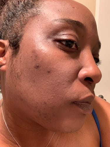 Customer photo review of BERRI-CLEAR+ 5 BERRY SUPERFRUIT SERUM