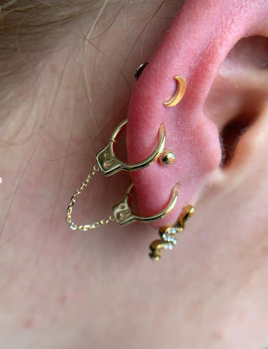 Customer photo review of Keloid Bump Shrinking Duo