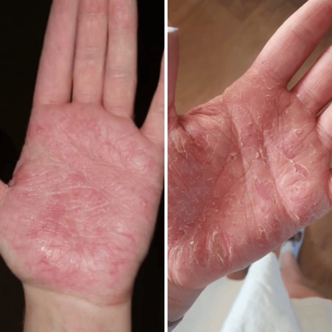 Customer photo review of HOCL Skin Healing Duo