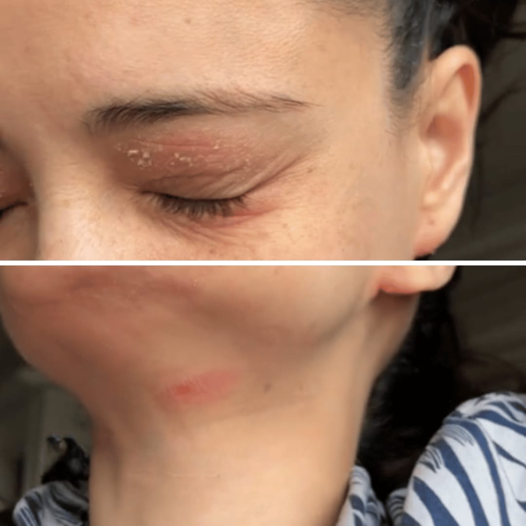 Customer photo review of HOCL Skin Healing Duo