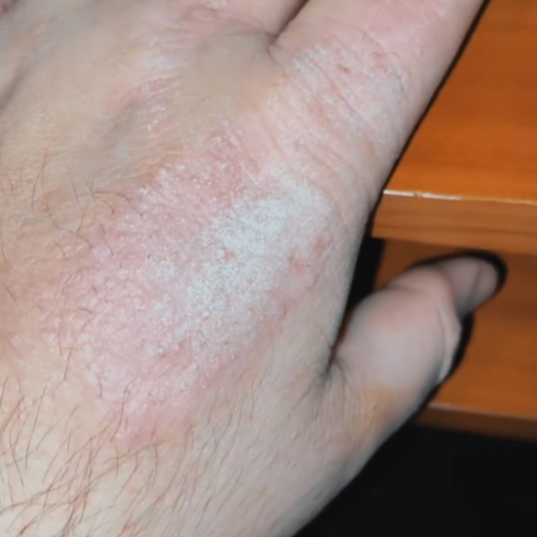 Customer photo review of HOCL Skin Healing Duo