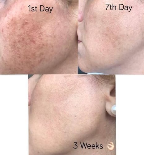 Customer photo review of DermaLaze Skin Rejuvenation System with IPL SHR & E-Light