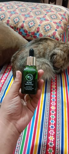 Customer photo review of Face Serum - Acne Treatment (30ml)