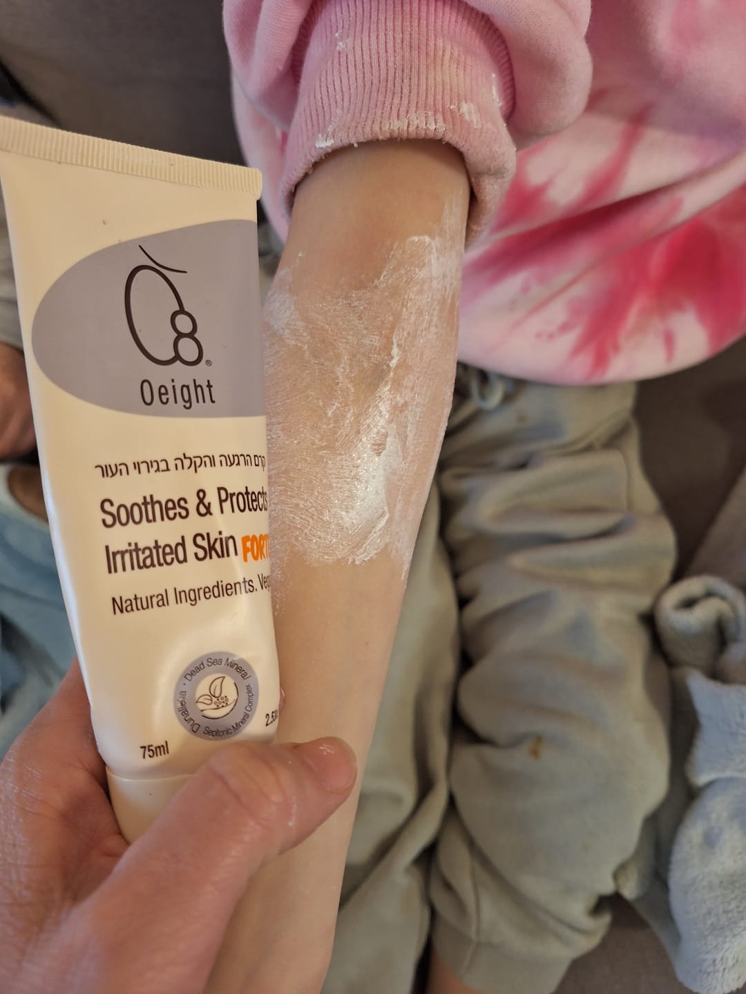 Customer photo review of קרם הרגעה והקלה בגירוי העור- פורטה- פתרון לגירויים, יובש או אדמומיות מכף רגל ועד ראש