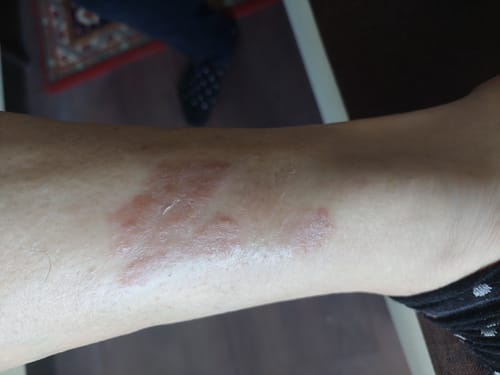 Customer photo review of Psoralyn - pikkelysömör elleni krém