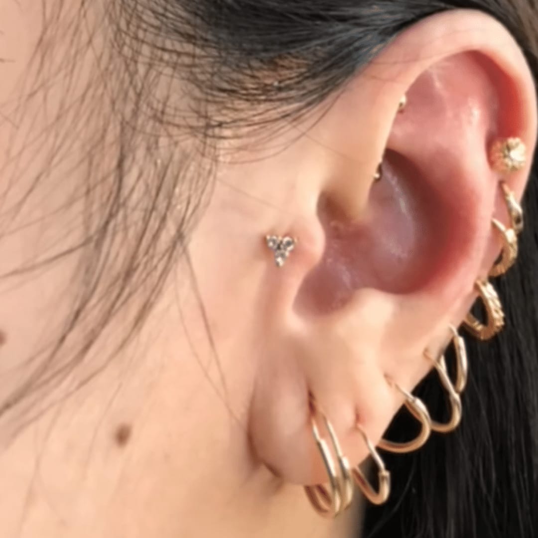 Customer photo review of Ultimate Keloid Scar Trio