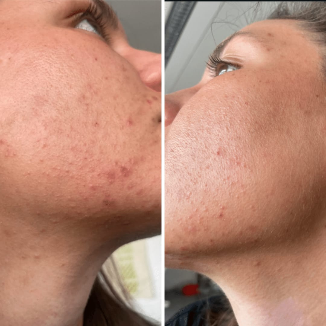 Customer photo review of Hypochlorous Acid Wipes for Skin & Face - 75 Ct