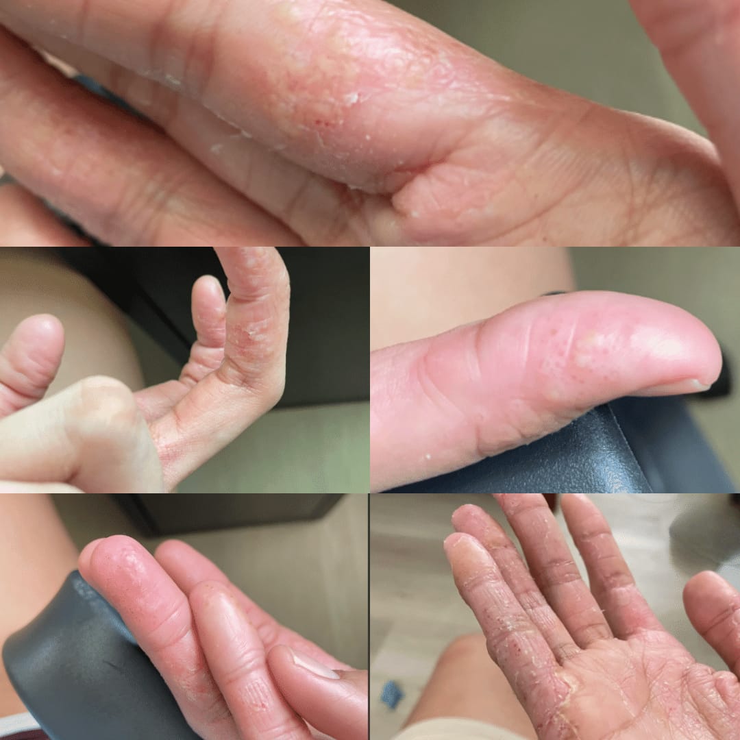 Customer photo review of Hypochlorous Acid Wipes for Skin & Face - 75 Ct
