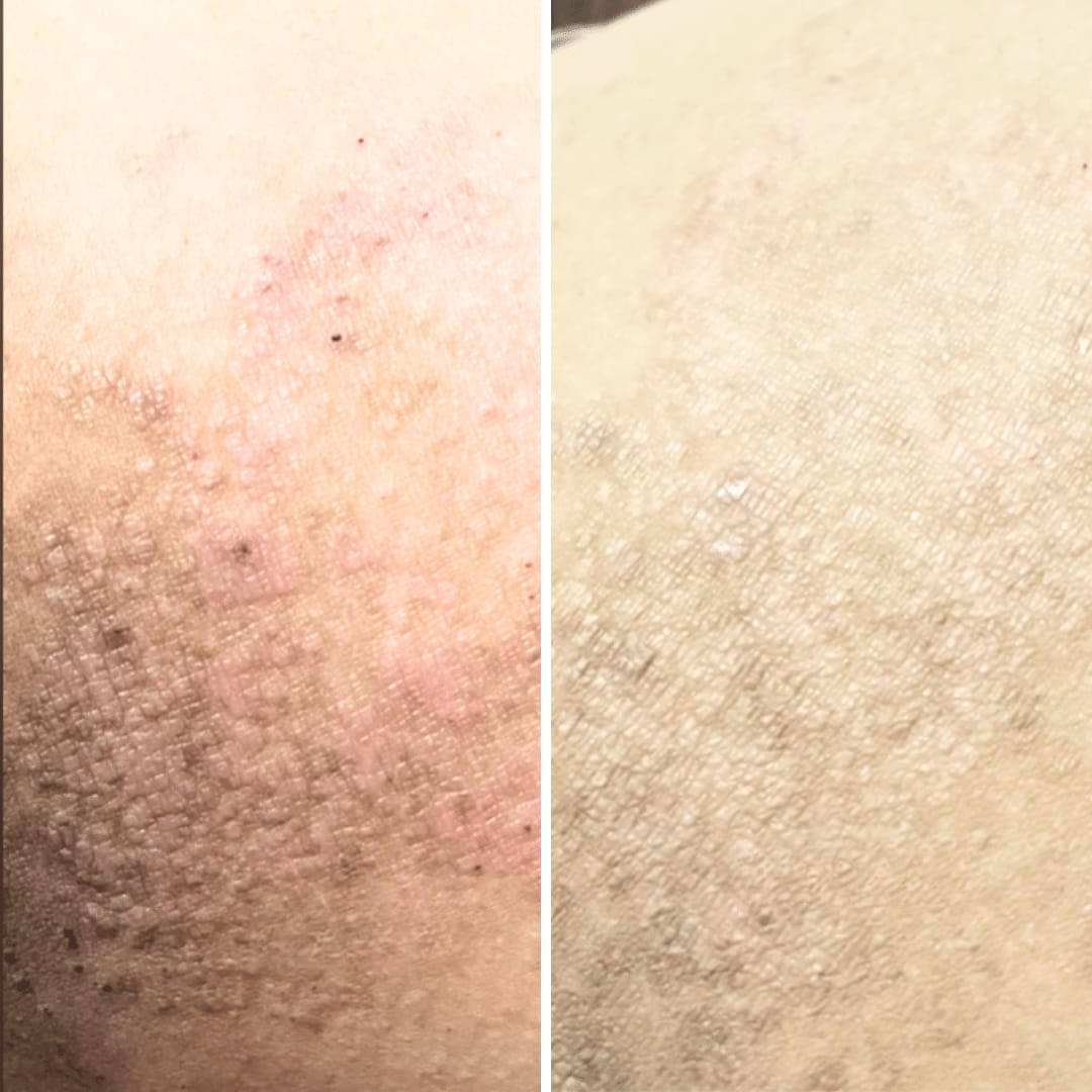 Customer photo review of Hypochlorous Acid Wipes for Skin & Face - 75 Ct