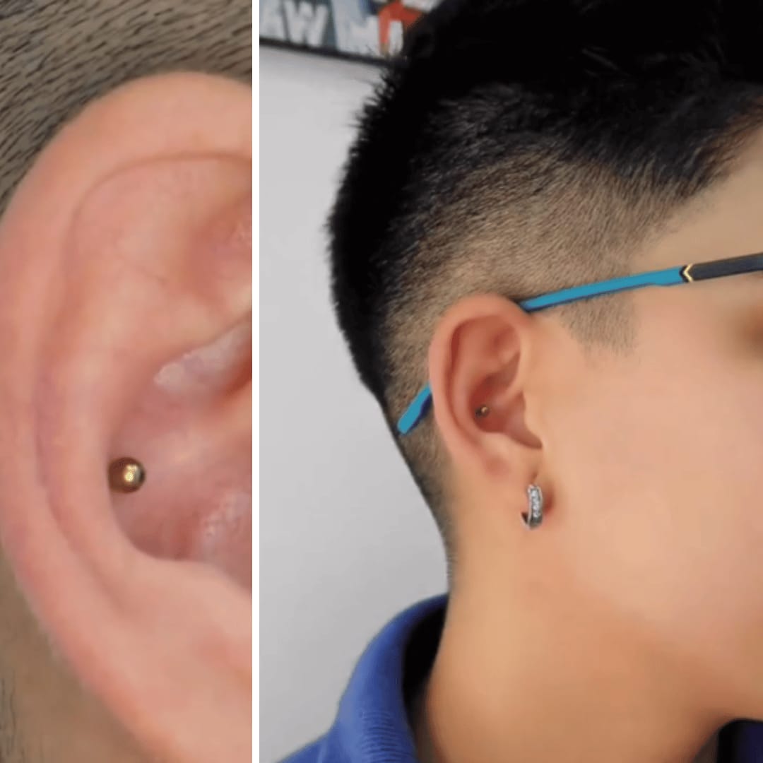 Customer photo review of Keloid Bump Shrinking Duo