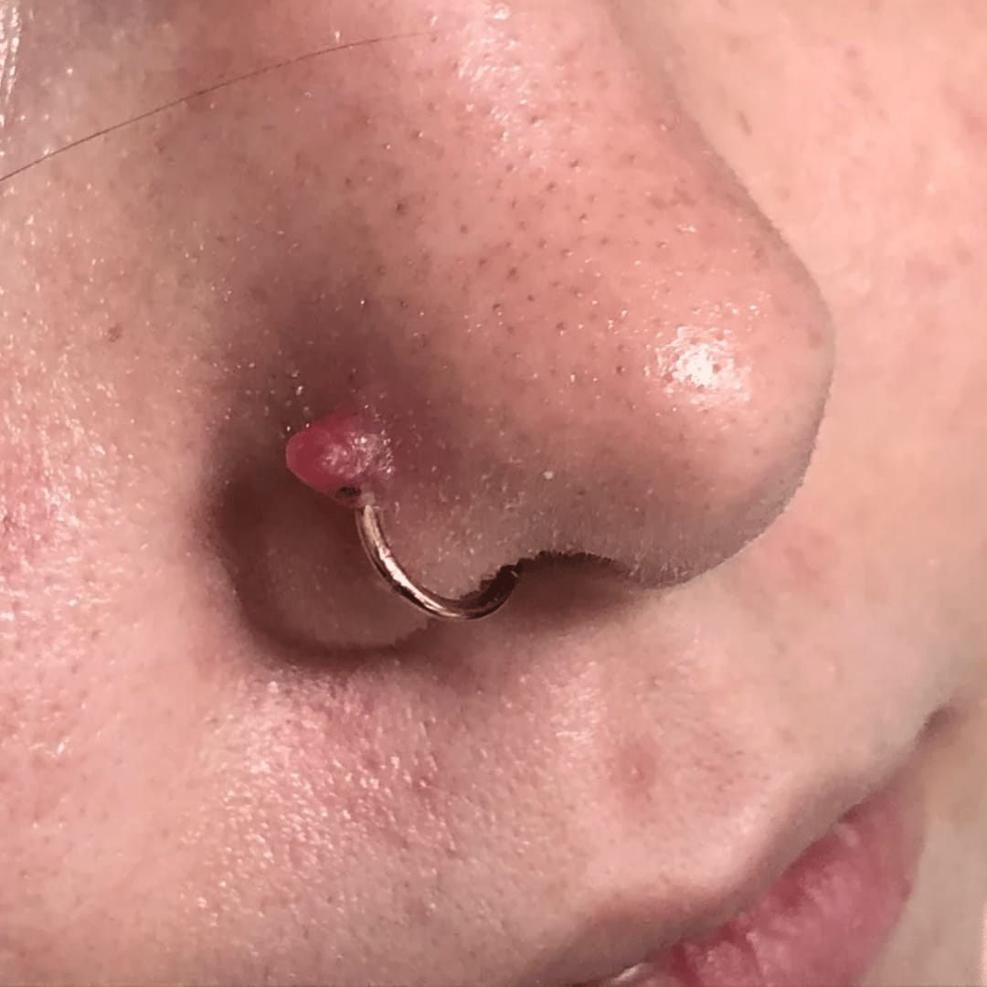 Customer photo review of Ultimate Keloid Scar Trio
