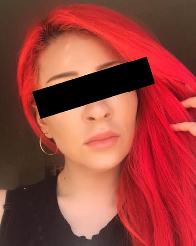 Customer photo review of WrinkleFix: Unlimited Toxins Membership Auto renew (Ships every 30 Days)