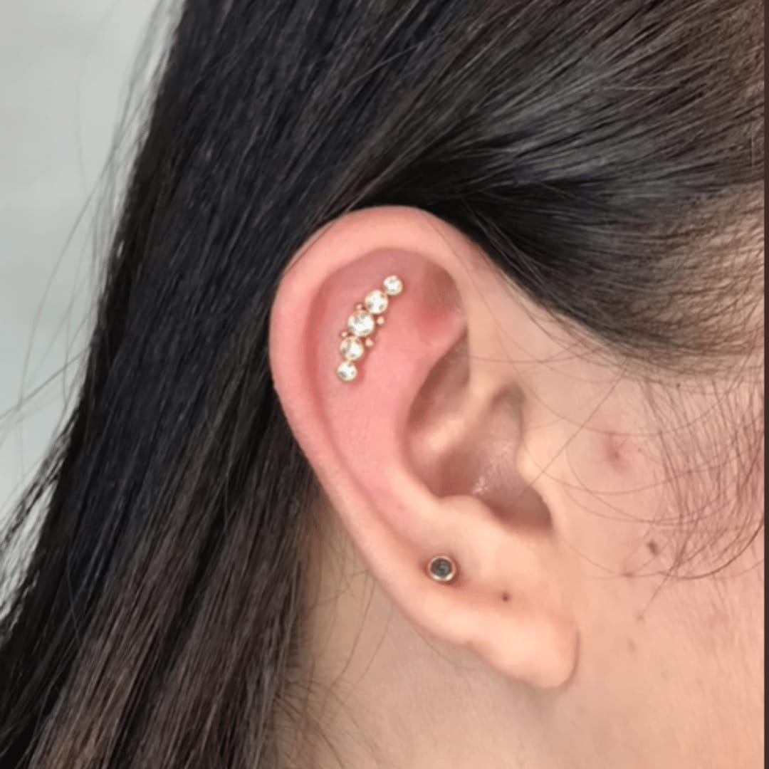 Customer photo review of Ultimate Keloid Scar Trio