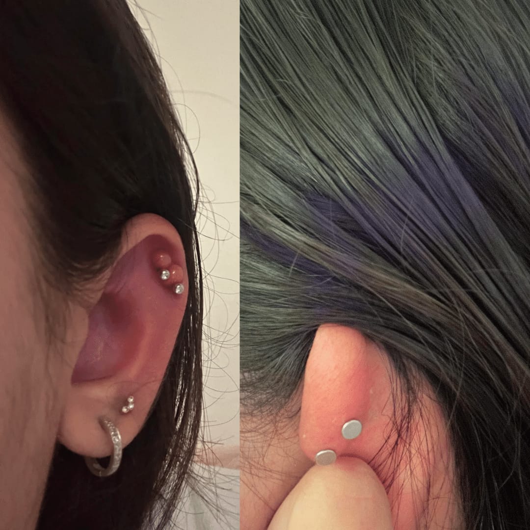 Customer photo review of Ultimate Keloid Scar Trio