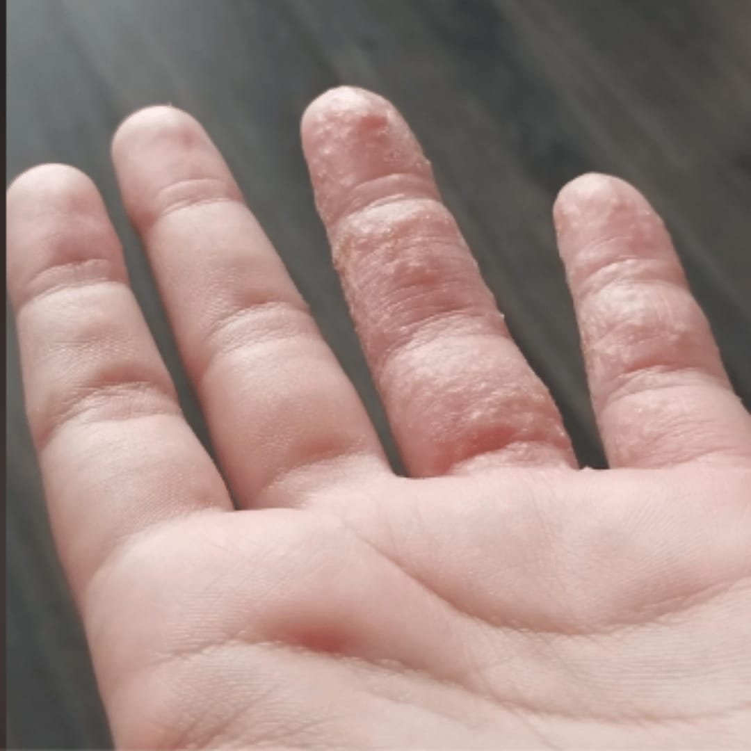 Customer photo review of Hypochlorous Acid Wipes for Skin & Face - 75 Ct