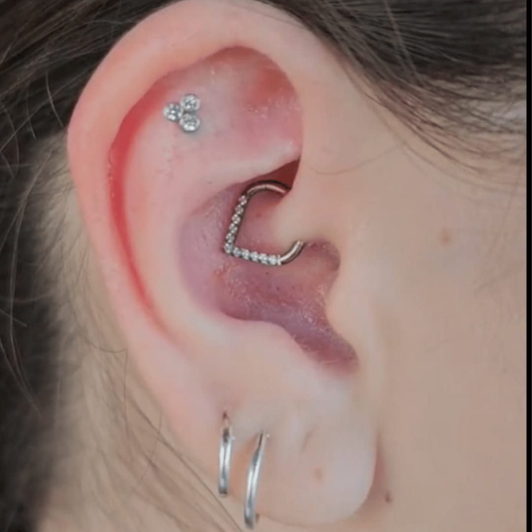 Customer photo review of Keloid Bump Shrinking Duo