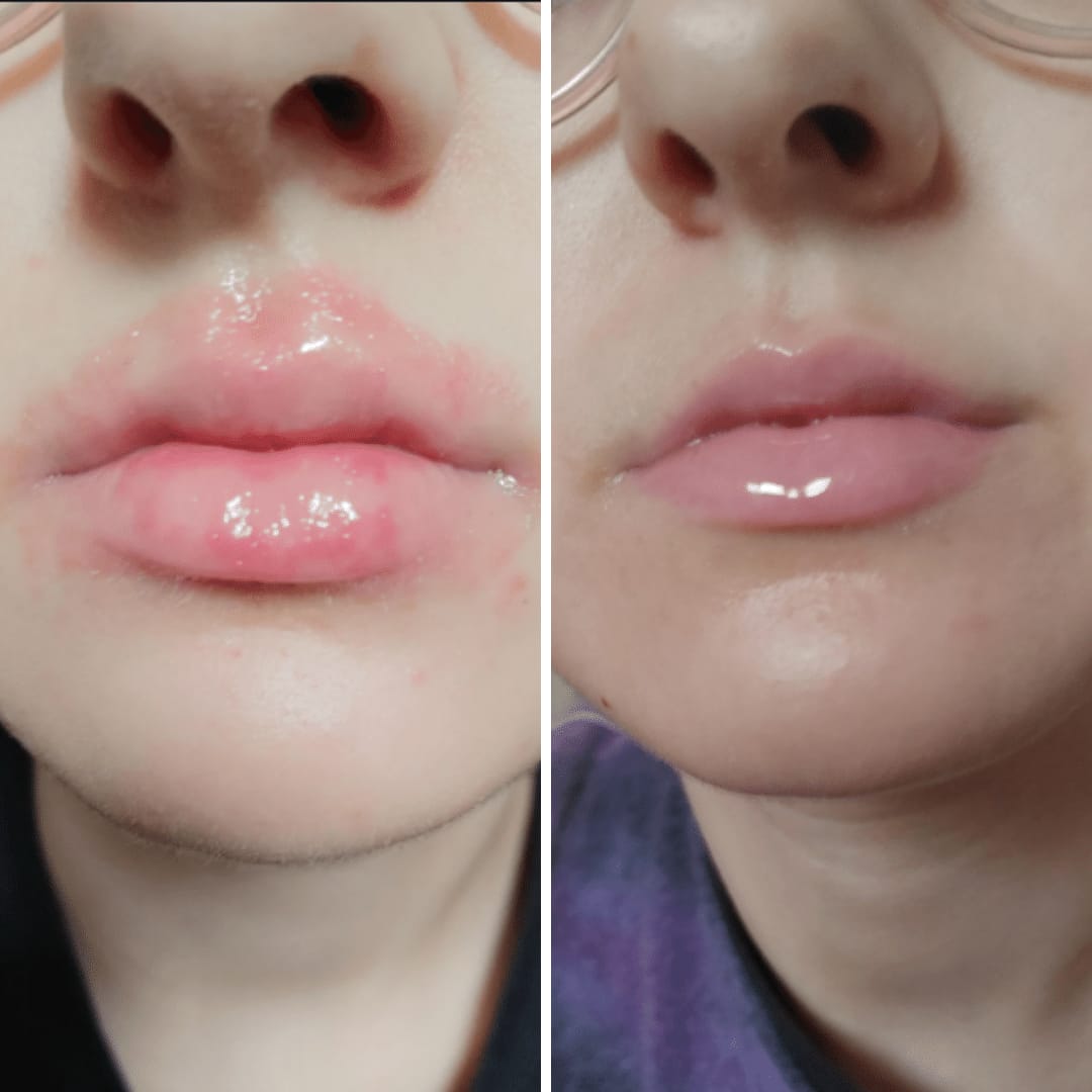 Customer photo review of Hypochlorous Acid Wipes for Skin & Face - 75 Ct