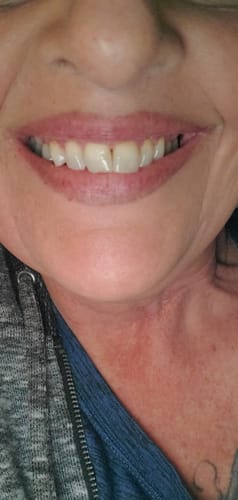 Customer photo review of Tri Pulse™ Whitening Kit