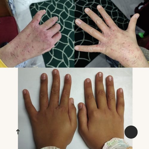 Customer photo review of Eczema Scratch Mitten