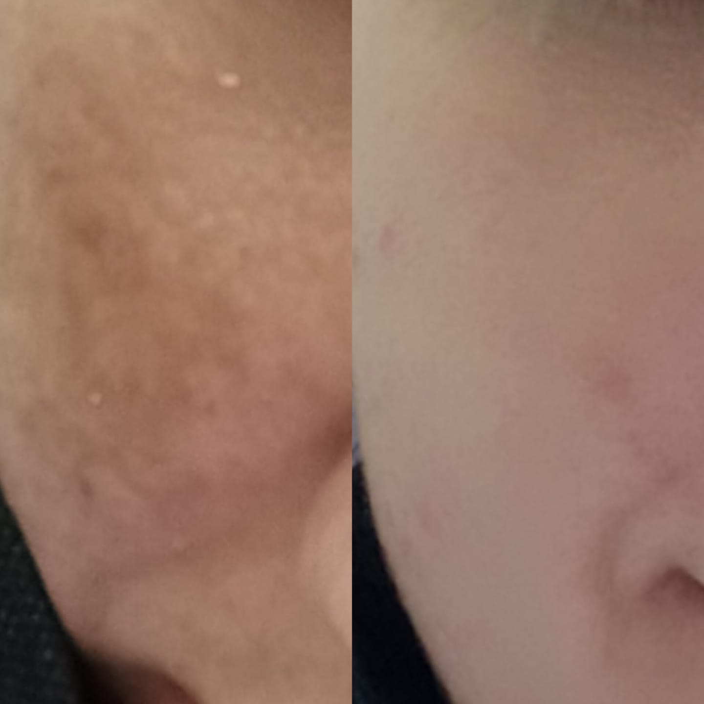 Customer photo review of SPECIAL PIGMENTATION BUNDLE (MELASMA, FRECKLES & DARK SPOTS)