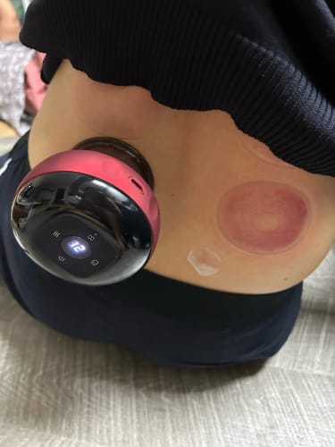 Customer photo review of The Pulse Cup™ Cupping Massager