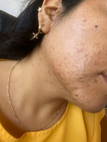 Customer photo review of Kit Antiacné