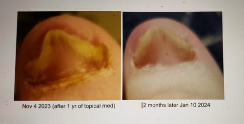 Customer photo review of Onychom - Antifungal Laser Device