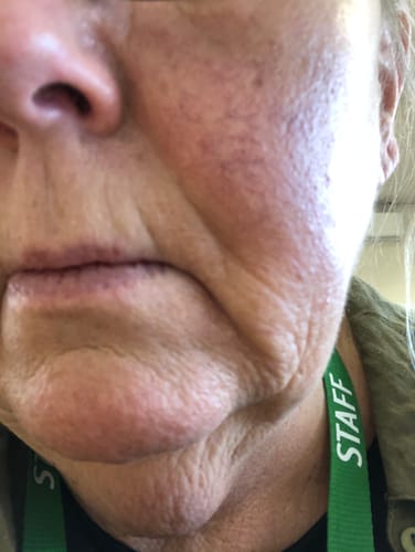 Customer photo review of Rosalique 3 in 1 Anti-Redness Miracle Formula SPF50