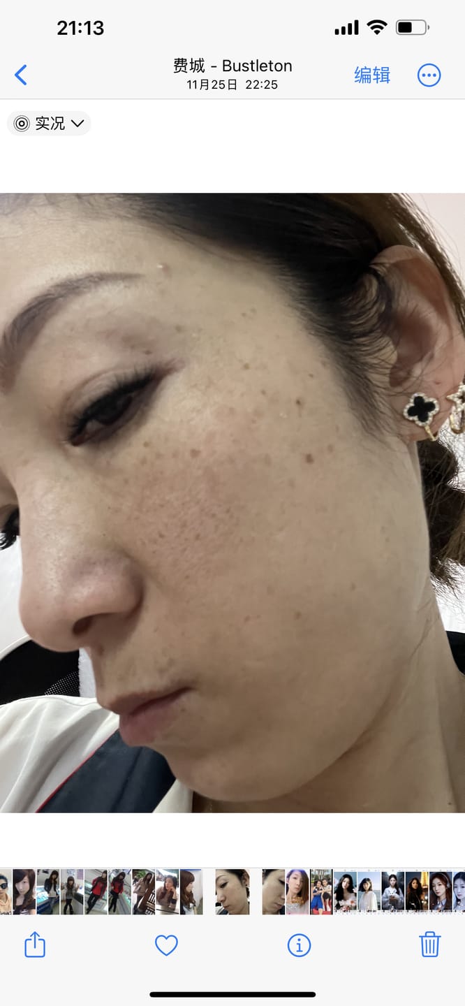 Customer photo review of JOVS Blacken PRO DPL Photorejuvenation Skincare Device
