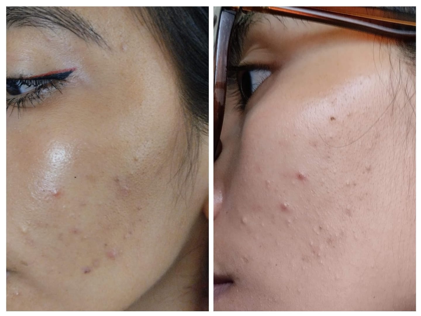Customer photo review of Serum facial Niacinamida, Vitamina E y Acido hialurónico tonificador aclarante y protector 50ml