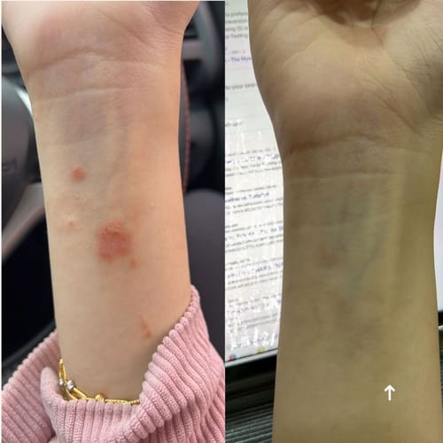 Customer photo review of Eczema Scratch Mitten