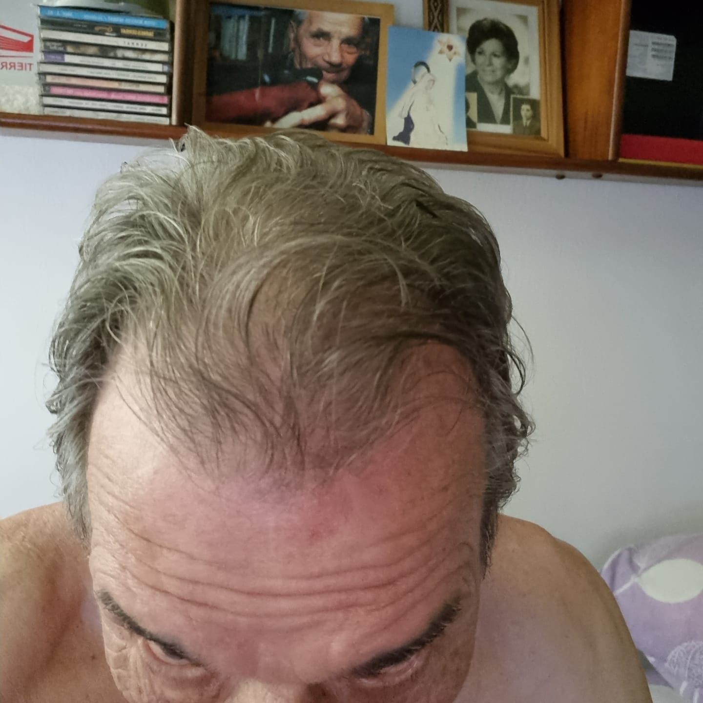 Customer photo review of Match Cuidado del pelo - Vitaminas Hairfy + Loción