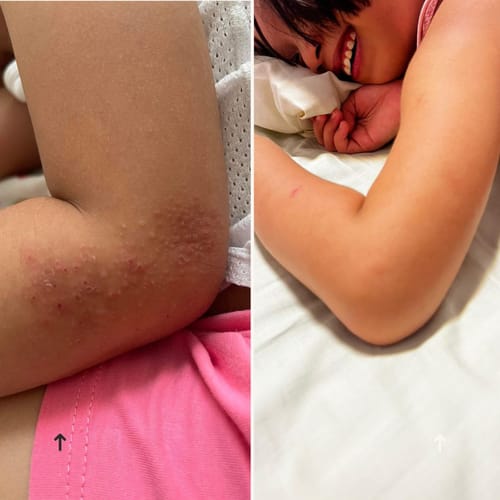 Customer photo review of Eczema Scratch Mitten