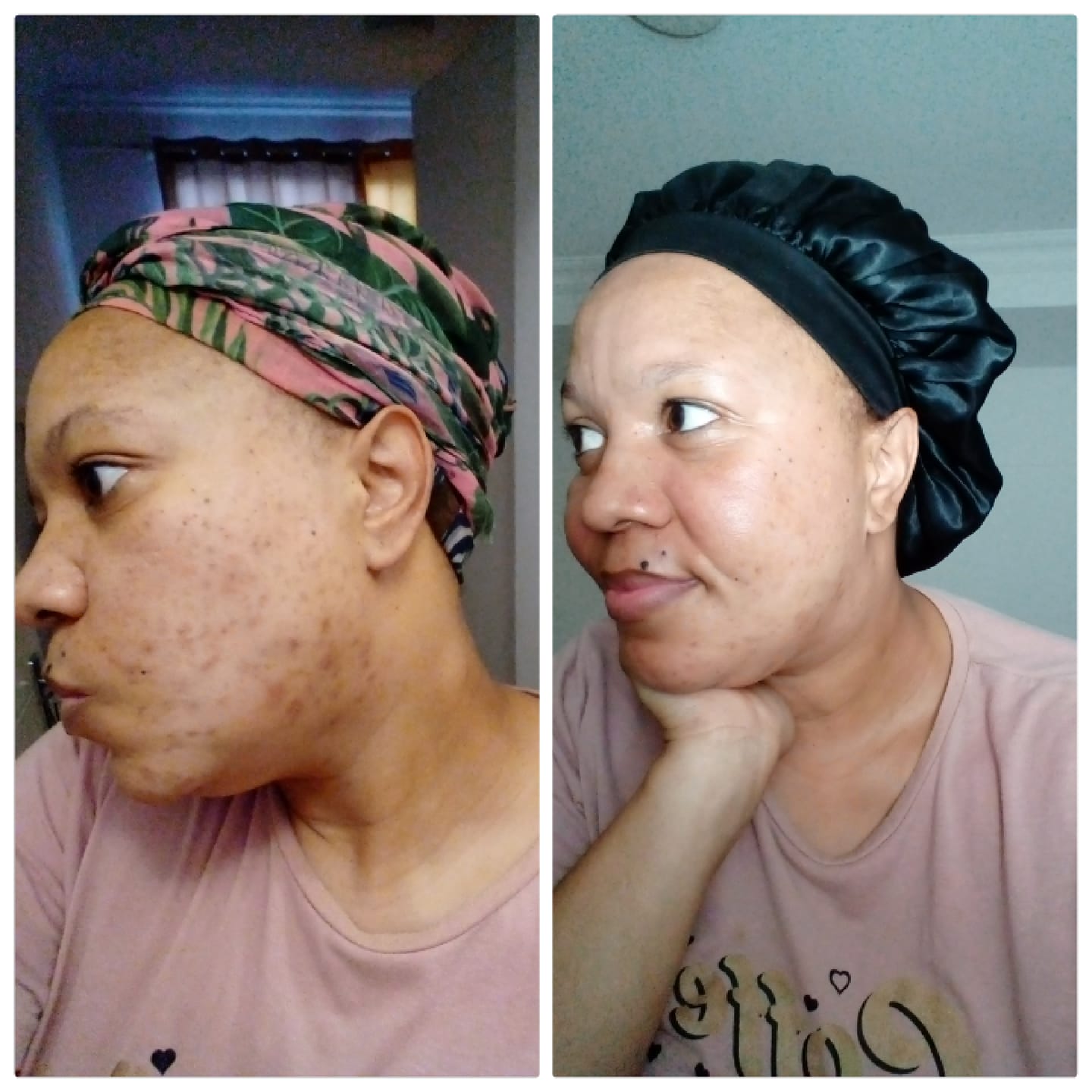 Customer photo review of Gmaeum Clear Complexion Set