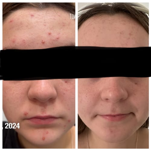 Customer photo review of Advanced Acne Program™