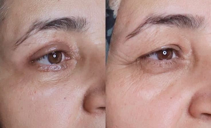 Customer photo review of Eye Roller | Eliminates Dark Circles & Puffy Eyes