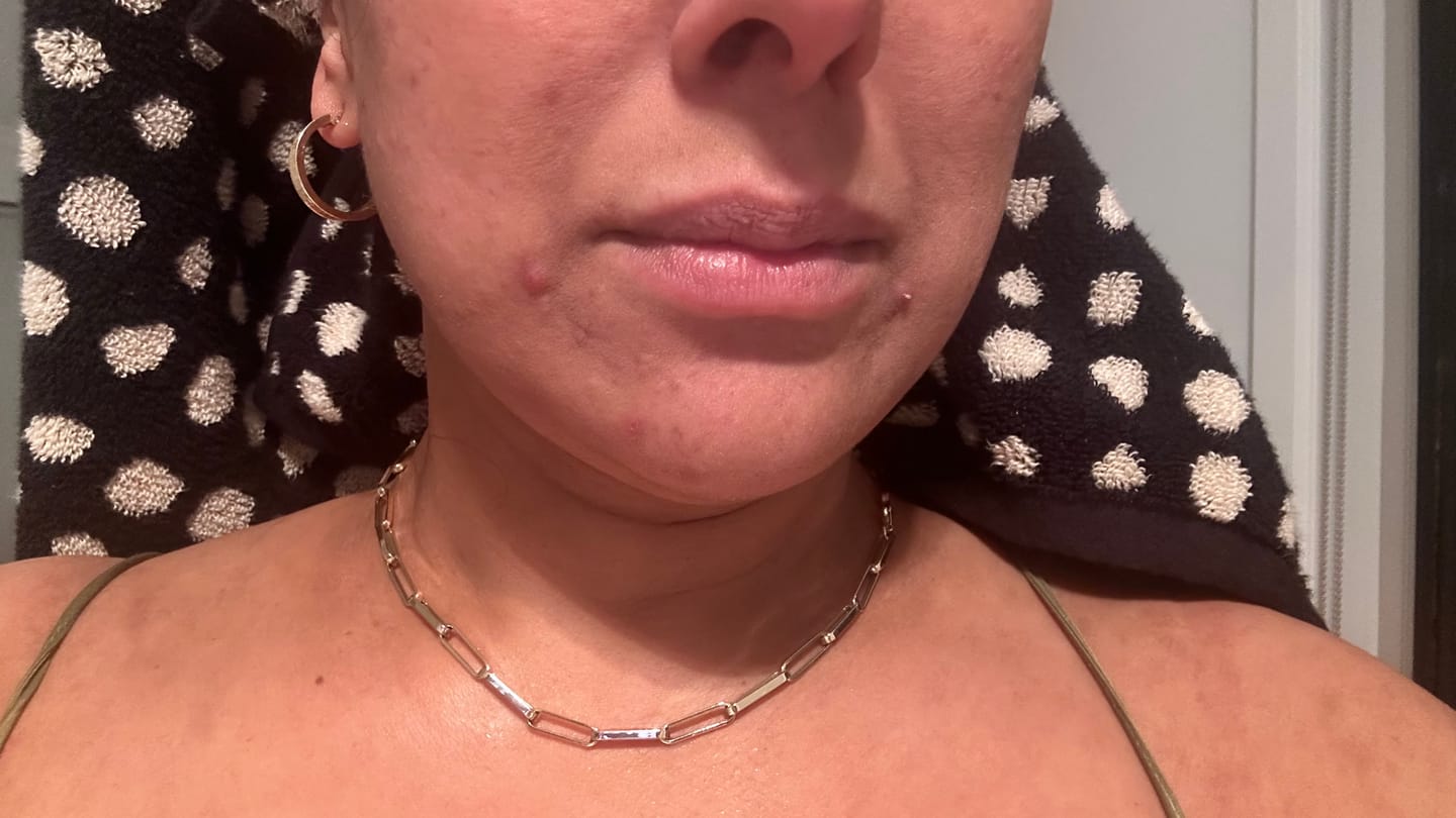 Customer photo review of Anti Acne Serum (Azelaic Acid 20% w/w, Niacinamide 10% & Vitamin E) (30ml)