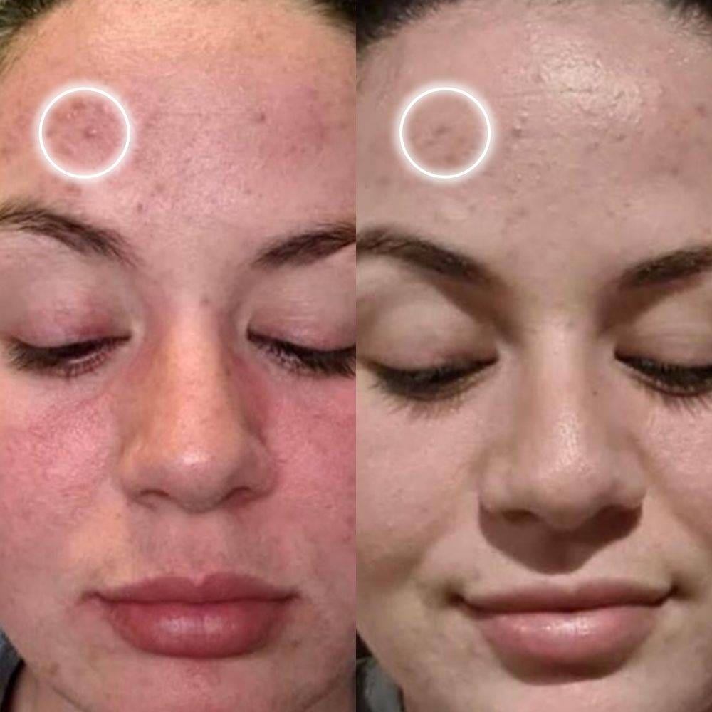 Customer photo review of MATTE Crema Matificante Anti-Acné