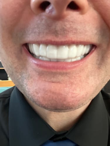 Customer photo review of Spare Veneers