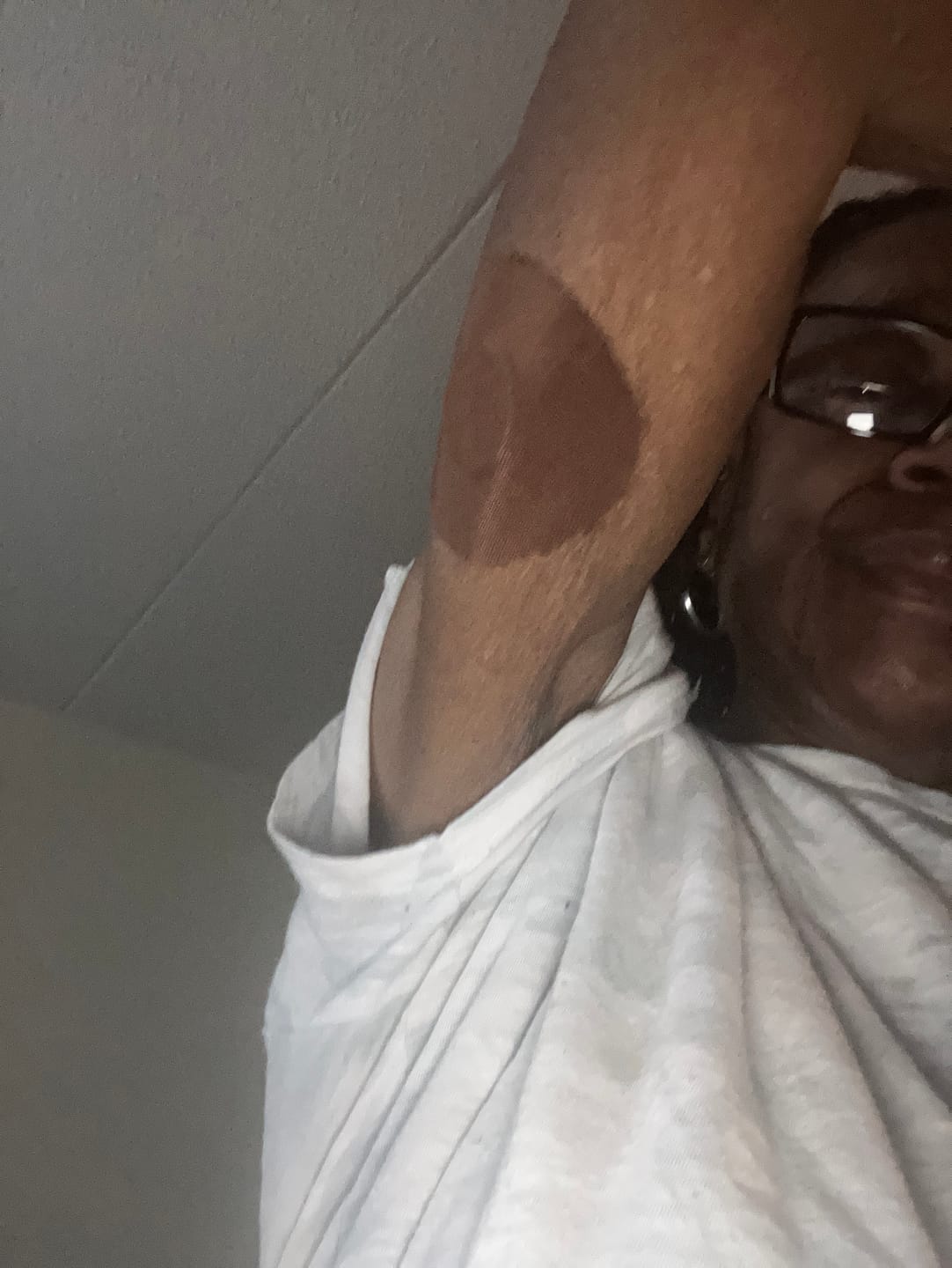 Customer photo review of Skin Grip Original - Freestyle Libre 2 Adhesive Patches