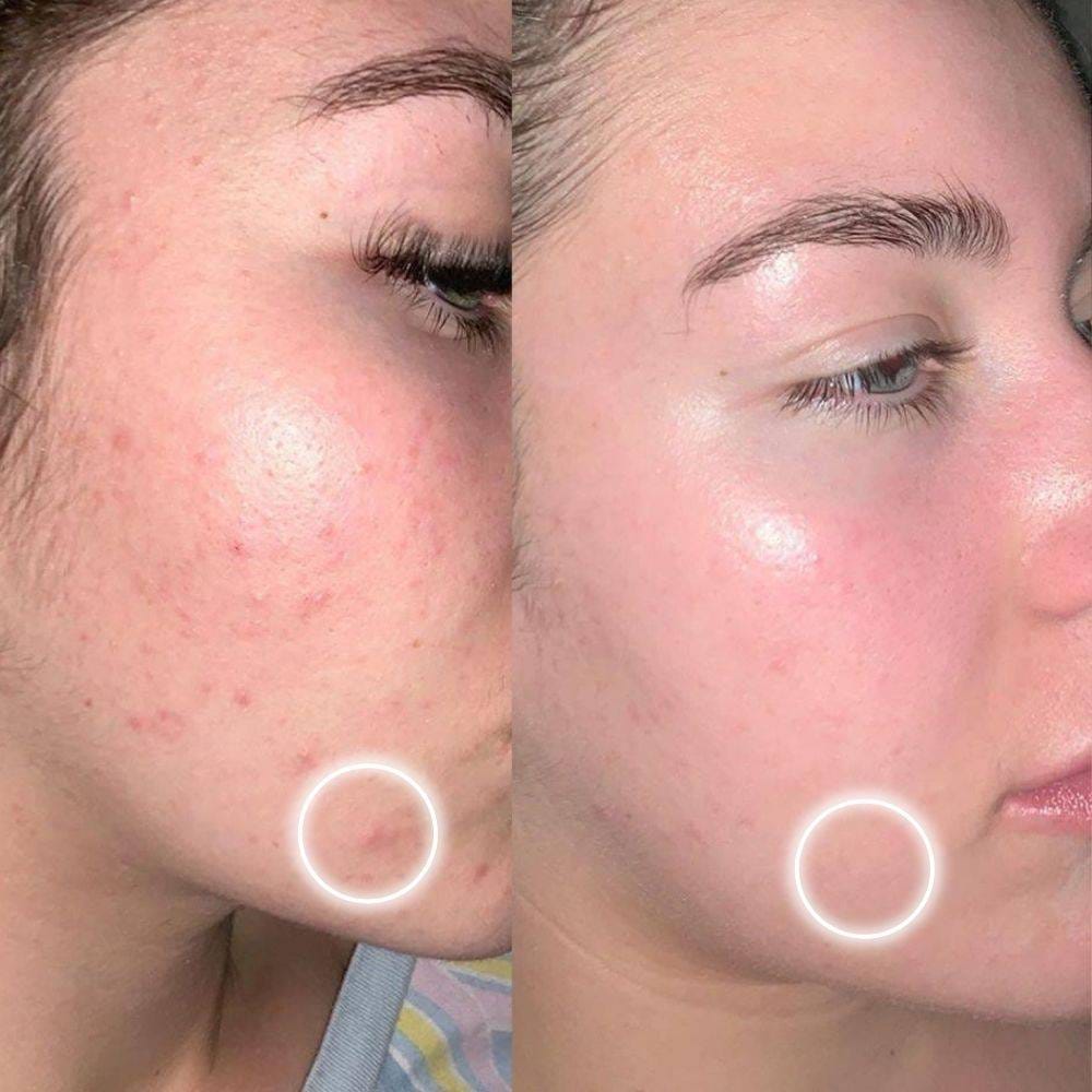 Customer photo review of MATTE Crema Matificante Anti-Acné