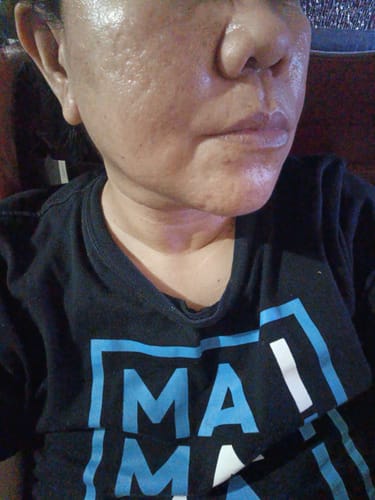 Customer photo review of Bad Skin™ Korean Collagen Bomb Hydrating Ampoule