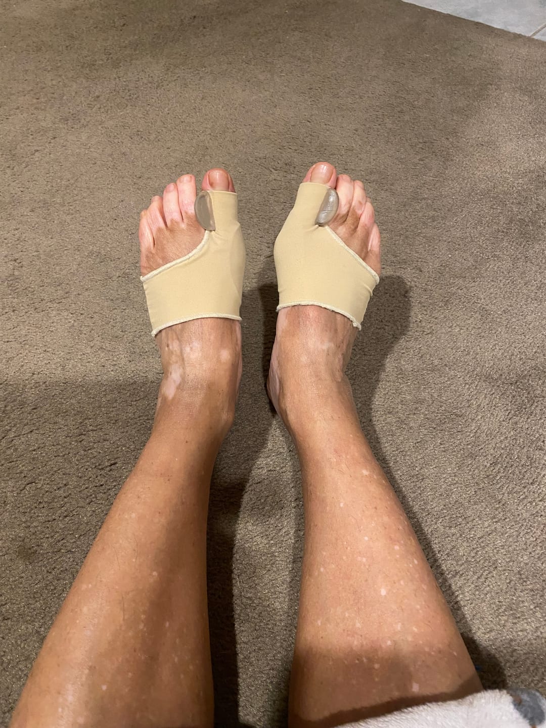 Customer photo review of Treatmedy™ Orthopedic Daytime Bunion Sleeve