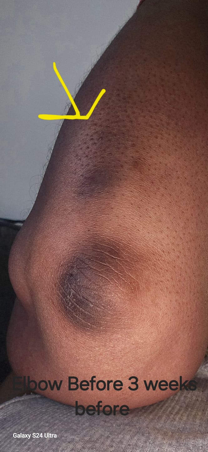 Customer photo review of Magic Eraser Dark Spot Cream