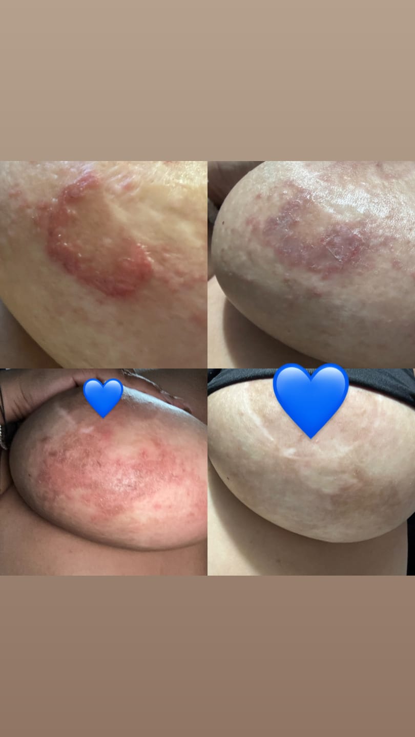 Customer photo review of Relieve Healing Gel